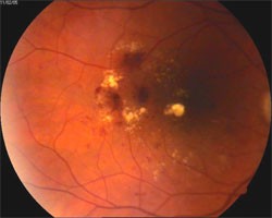 retinopatia_cukrzycowa